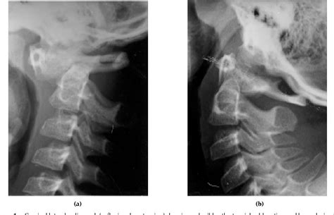 Figure 1 From Retrodental Synovial Cyst Which Disappeared After