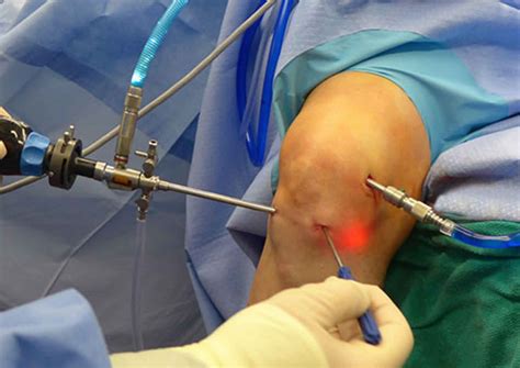 Best Knee Arthroscopy Surgeondoctor In Gota Knee Arthroscopy In Gota