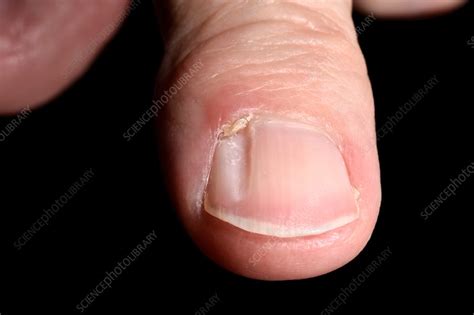 Grooved Nail With Mucous Cyst Stock Image C0426366 Science Photo