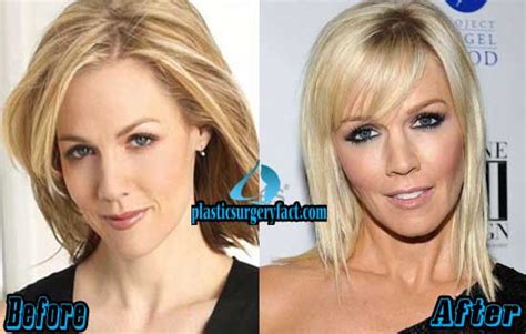 Jennie Garth Plastic Surgery Before And After Photos