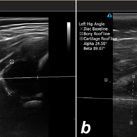 Symmetric Skin Creases Of A Patient With Bilateral Hip Dysplasia