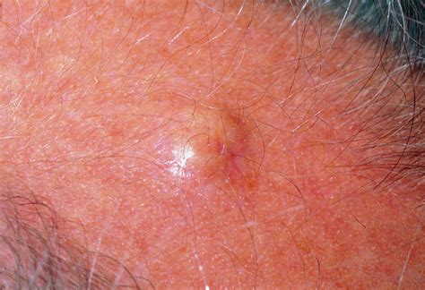 Sebaceous Cyst On Scalp Photograph By Dr H C Robinson Science Photo Library Pixels