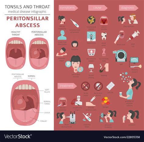 Tonsils And Throat Diseases Peritonsillar Abscess Vector Image 69936