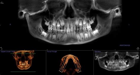 Cone Beam CT Imaging Springfield MO Dentist Buzbee Dental