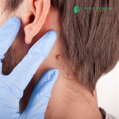 Expert Mole Removal Beverly Hills Laser Mole Removal