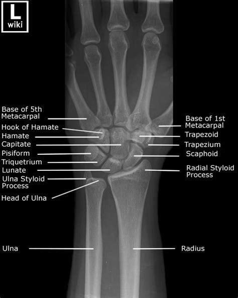 Pelvis Radiographic Anatomy WikiRadiography Hand Bone Anatomy Wrist Anatomy Anatomy Bones