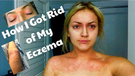How I Got Rid Of My Eczema My Eczema Story And Update Youtube