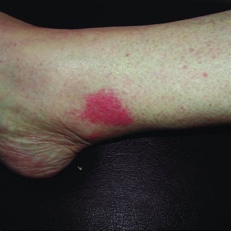 Well Demarcated Plaque Of The Right Leg With Erythema And Edema