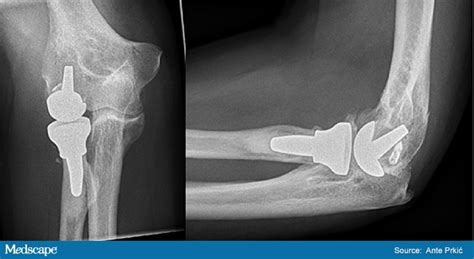 Total Elbow Arthroplasty The State Of Clinical Practice