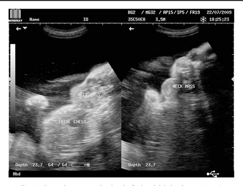 Figure 1 From Prenatal Ultrasonographic Diagnosis Of Fetal Neck