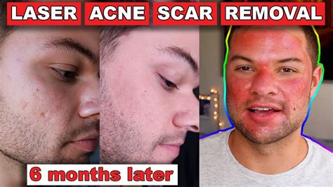 acne scar removal before and after 6 months fractional c02 laser skin resurfacing youtube