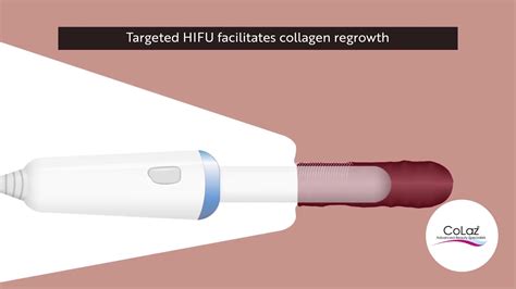CoLaz FemiWand Non Surgical Vaginal Tightening YouTube