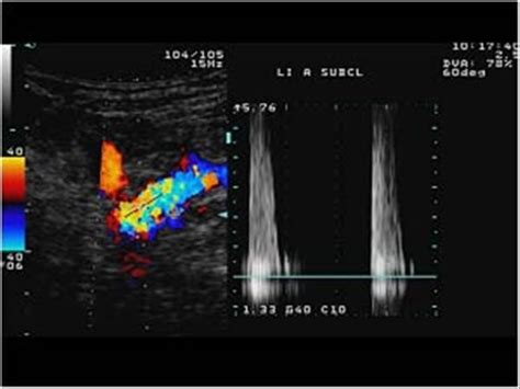 Subclavian Artery Ultrasound
