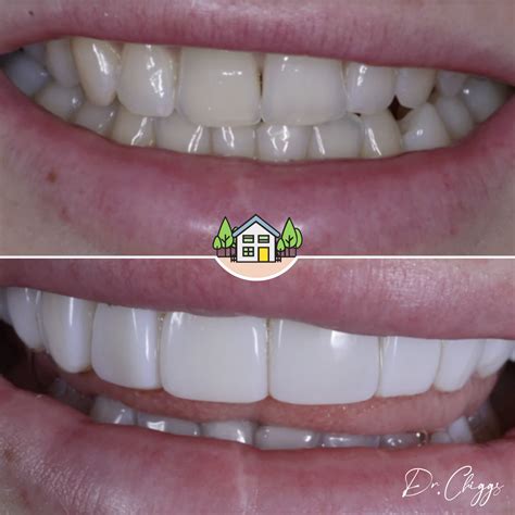 Composite Veneers Vs Porcelain Which Is Best The Dental House