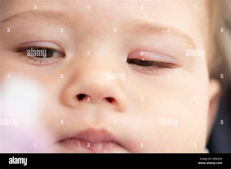 White Pimple On The Eyelid Of A Small Child Close Up Inflammation Of