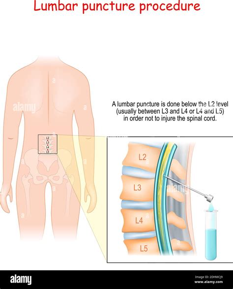 Lumbar Puncture Needle Hi Res Stock Photography And Images Alamy