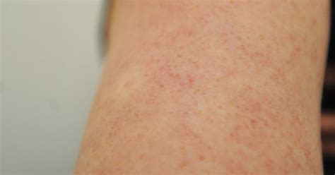 Keratosis Pilaris On Arms Chicken Skin Condition Chicken Skin