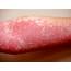 Urticaria Hives  Pictures Symptoms Causes Treatment Home