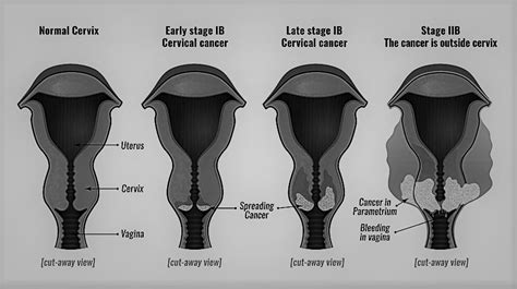 Cervical Cancer Revised Figo Staging The Physiologist Perspective