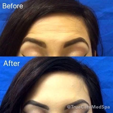 2000 surgeries per year · all inclusive price Eyebrow Lift Using Botox » Eyelid Surgery: Cost, Photos ...