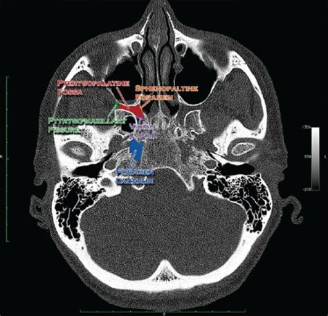 Ct Scan Bone Window Axial Section Through The Medial Open I