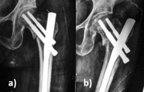 Pfn With Screw Back Out A Post Operative X Ray—fracture Fixed With