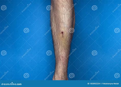 Bruise And Clotted Blood On The Leg Of A Young Man Stock Photo Image
