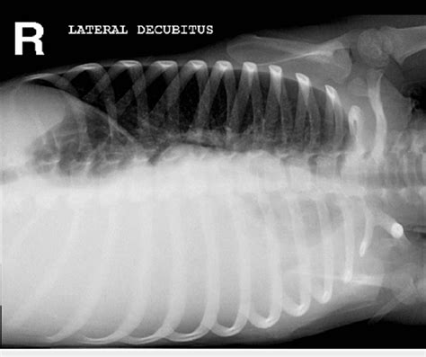 Plain Chest X Ray Right Lateral Decubitus View Showing A Large Free