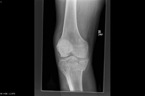 Tibial Plateau Fracture 2 Radrounds Radiology Network