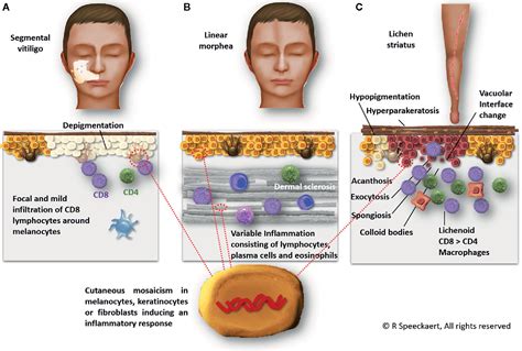 Frontiers Autoimmunity In Segmental Vitiligo