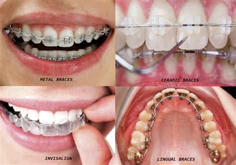 Types Of Dental Braces Explained Tooth Doctor Reverasite