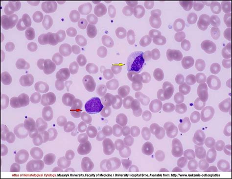 Myelodysplastic Syndrome With Excess Blasts Mds Eb 1 Cell Atlas