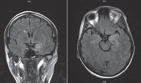 Traditionally on mri, herpes simplex encephalitis exhibits bilateral asymmetrical involvement of the. Herpes Simplex Virus Encephalitis | Neurology