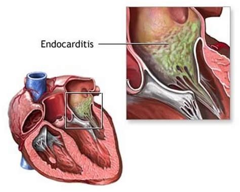 Endocarditis Disease With Causes And Nursing Intervention