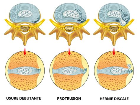 Hernie Discale Protrusion Discopathie
