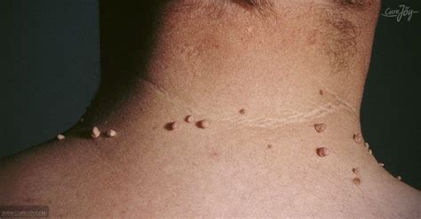 she had skin tags around her neck but she removed them with this simple solution Отбеливание