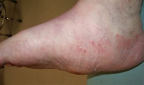 Charcot Foot Pictures Causes Symptoms Treatment Surgery Healthmd