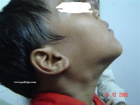 Medical Pics Cervical Lymh Nodes Jugulodigastric Node