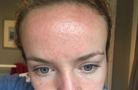 Big Rash On Forehead Months After Accutane Finished Accutane Isotretinoin Logs Acne Org