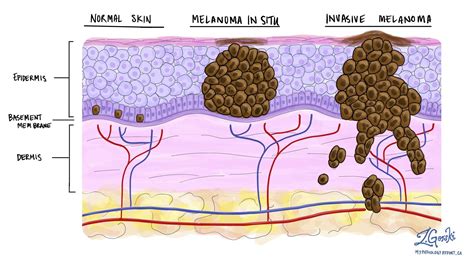 Melanoma In Situ Of The Skin Mypathologyreportca