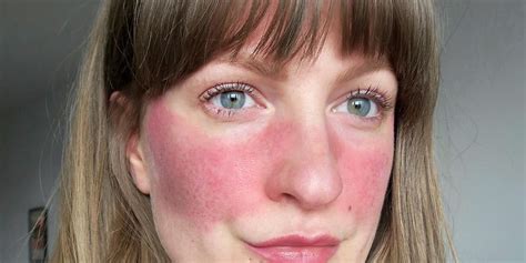 11 People Describe What Its Really Like To Have Rosacea