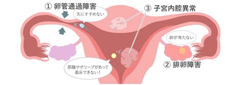 初めて不妊治療を受けられる方へ 神戸元町夢クリニック：不妊治療体外受精