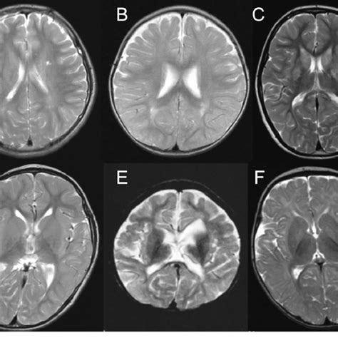 Nonspecific Brain Findings On T2 Weighted Mri A Case 5 Mild