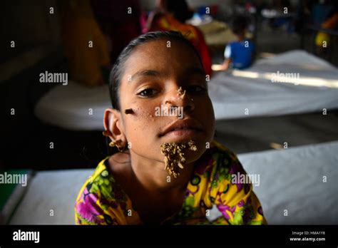 Bangladeshi Patient Sahana Khatun 10 Poses For A Photograph At The