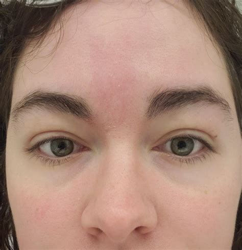 Skin Concern Help With Redness On Forehead And Cheeks Also Need