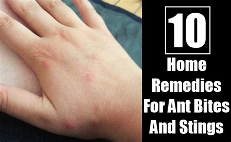 10 Amazing Home Remedies For Ant Bites And Stings Morpheme Remedies