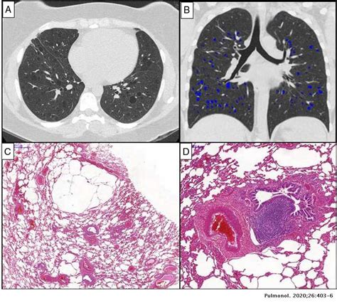 Diffuse Cystic Lung Disease As The Primary Tomographic Manifestation Of
