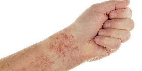 It turns out, scientists have historically disagreed on the answer. Skin rash and sexually transmitted diseases