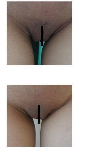 大陰唇縮小形成手術、小陰唇縮小形成術、陰核包皮縮小形成術