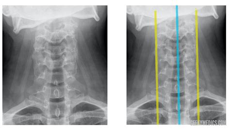 Cervical Spine X Ray Interpretation Osce Guide Laptrinhx News